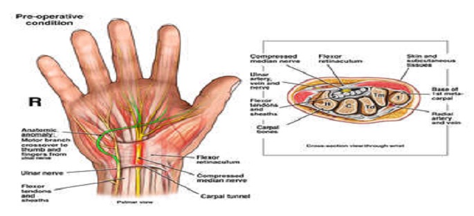 Carpal Tunnel Syndrome Discharge Instructions